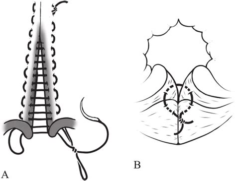 Schematics Of The Suture Technique The Vaginal Roof Was Closed With