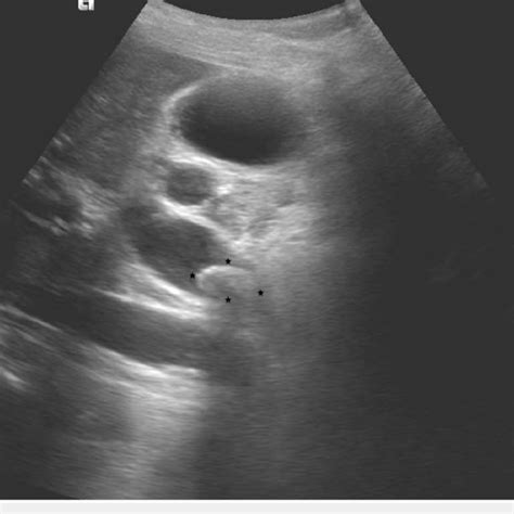 Ultrasound Showing Significant Proximal Common Bile Duct Dilatation