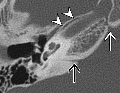 Temporal Bone Trauma Typical Ct And Mri Appearances And Important