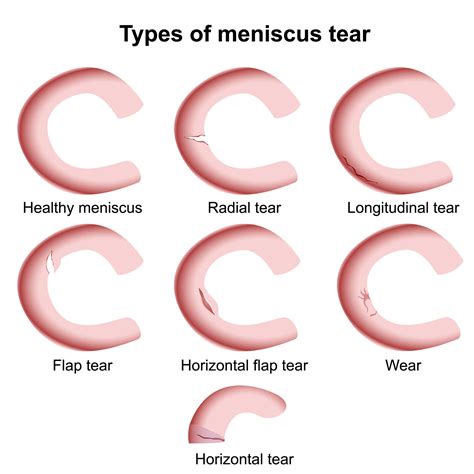 Meniscal Cartilage Tear Exercises Illustration Knee S