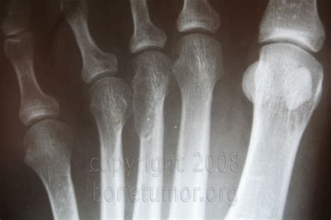 Enchondroma Foot And Ankle