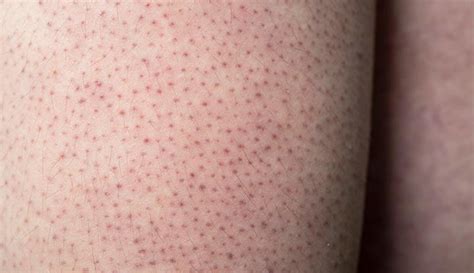 Keratosis Pilaris What It Is Causes Symptoms And Treatment