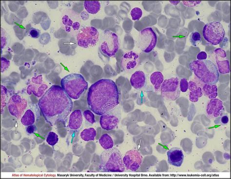 Polycythaemia Vera Pv Cell Atlas Of Haematological Cytology