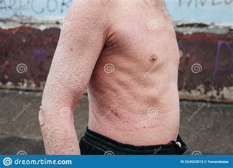 A Man With Psoriasis On His Back And Neck Scratch With His Hand