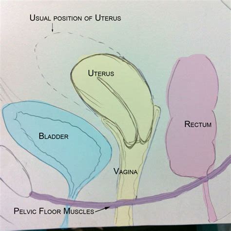 Female reproductive organs in the pelvic cavity include the uterus, ovaries and fallopian tubes. Pelvic Organ Prolapse - Part 1