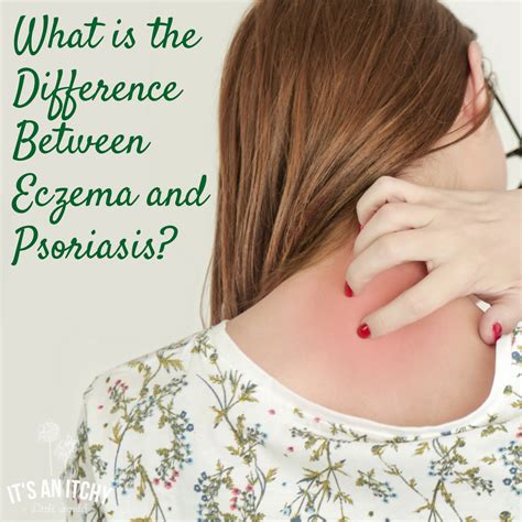 Eczema And Psoriasis Whats The Difference