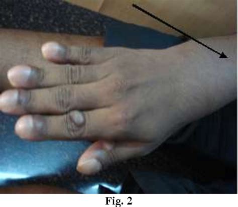 Figure 2 From Primary Hypertrophic Osteoarthropathy And Successful
