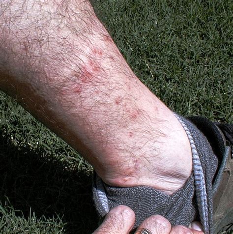 Your environmental surroundings are a clue, tania elliott, md, who works in nyu langone's department of infectious disease , allergy and. Chiggers, fleas more noticeable in summer