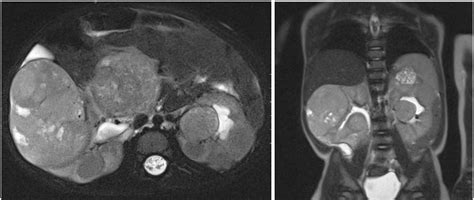 Figure 1 From Extensive Synchronous Bilateral Wilms Tumor Treated With