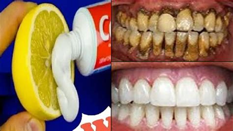 Most stains are caused by foods and drinks, and yellowness can also be caused by your diet. Magical Teeth Whitening Remedy, Get whiten Teeth at home ...