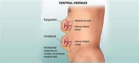 @article{bubiakina1995femoralhi, title={femoral hernia in a child.}, author={n. Signs and Symptoms of Hernia in your Child - Neoalta ...
