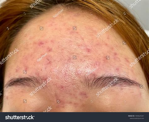 Multiple Illdefine Erythematous Rash Forehead Lady Stock Photo