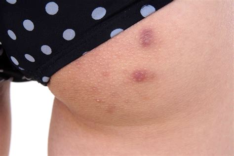 What Causes Butt Pimples
