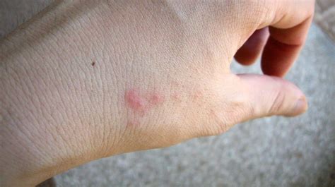 Itchy Bumps On Skin Like Mosquito Bites What Are They Skin Bumps Itchy Bumps Signs Of Bed
