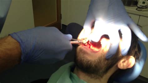 Tooth Being Pulled Out By Dentist Very Graphic Sfw Youtube