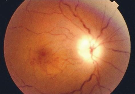 Fundus Photograph Of Right Eye Showing Pallid Edema Of Open I