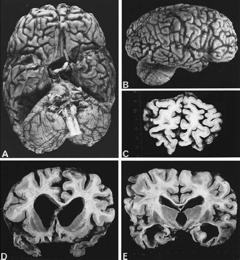 Macroscopic Appearance Of The Fixed Brain After Autopsy A And B