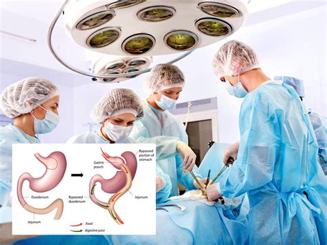 How Does Bariatric Surgery Work Laparoscopic Gastric Lap Band