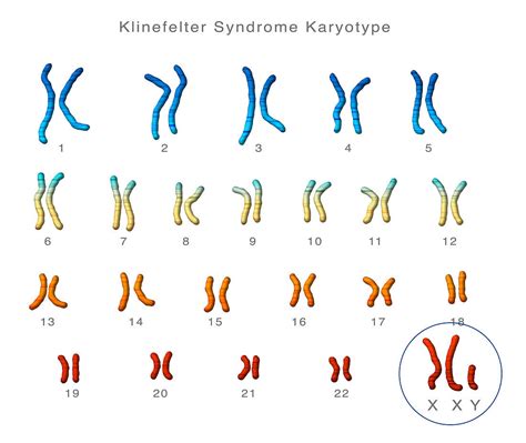 Klinefelter S Syndrome Karyotype Stock Image C0220583 Vrogue Co