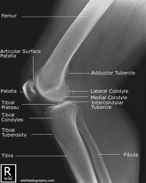 There mild or borderline patella alta. Radiographic anatomy of the knee (lateral view ...