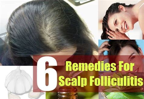 How To Treat Folliculitis On Your Scalp