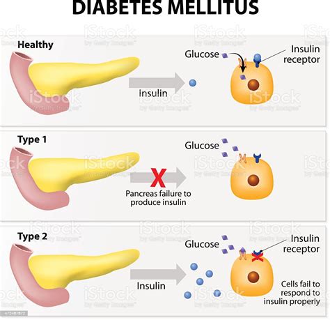 This is a condition in which your body doesn't produce or use adequate amounts insulin to function properly. Ilustração de Diabetes Mellitus e mais banco de imagens de ...
