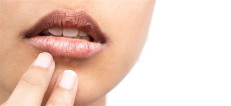 Dry Mouth Syndrome Symptoms Causes Treatments