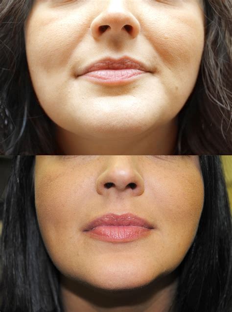 Before And After Juvederm Facial Fillers Botox Clinic Botox Fillers