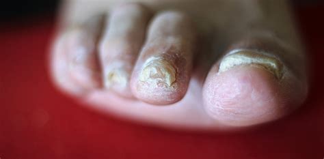 Explainer Why Do We Get Fungal Nail Infections And How Can We Treat Them