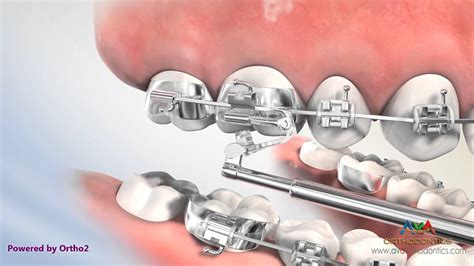 Orthodontic Treatment For Overjet Overbite Esprit Appliance Youtube