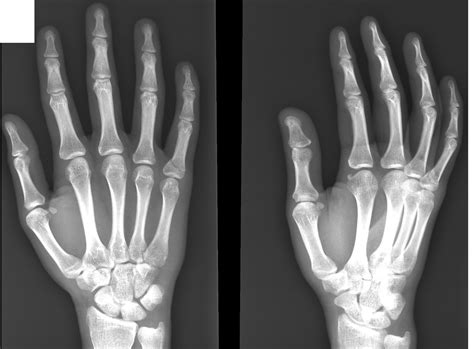 Hand X Ray Causes Symptoms Treatment Hand X Ray