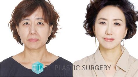 Korean Tl Plastic Surgery Everyone Has The Right To Look Beautiful