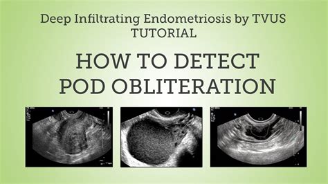 Were small cysts and more fluid in the pouch of pod cast in ultrasound is prediction of diagnosis. Pouch of Douglas Obliteration Detection by TVUS Tutorial ...