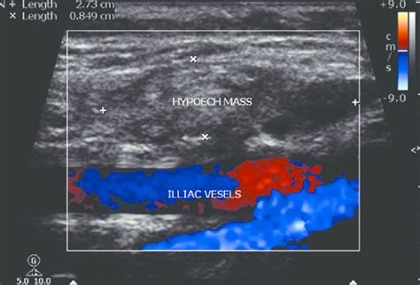 Ultrasound Picture Of Hypoechoic Mass Involving Muscle Download