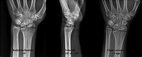 Radiological Evaluation Of The Distal Radius If Radial Inclination