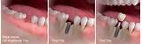 Pictures of Dental Implant Steps Pictures