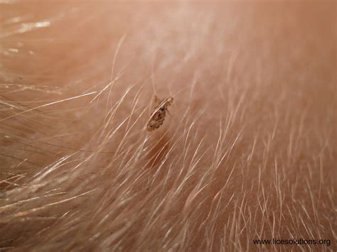 Head Lice Female Louse On Hair Zoomed In On A Female Lou Flickr