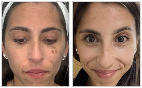 Moxi Laser Treatment Skin Science Clinic