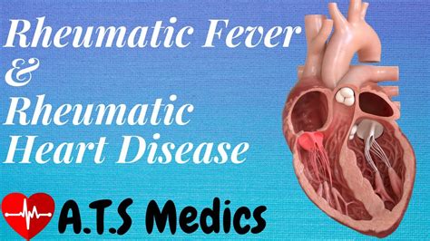 Acute Rheumatic Fever Chronic Rheumatic Heart Disease Youtube
