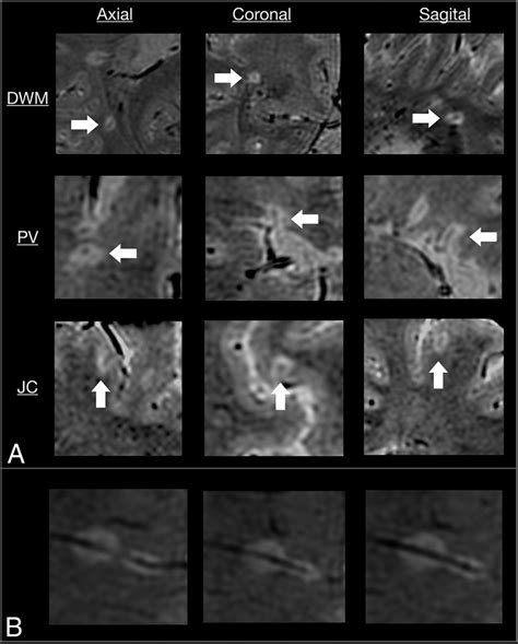 Swan Venule An Optimized Mri Technique To Detect The Central Vein Sign