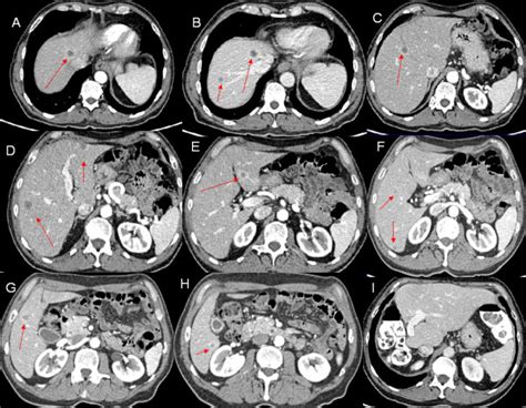 Computed Tomography Scan Of Liver Metastases Prior And After Surgery