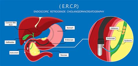 Ercp Stent