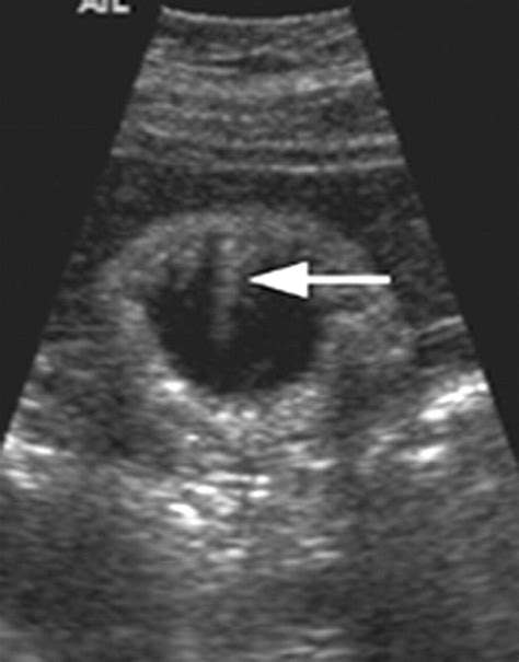 Adenomyomatosis Of The Gallbladder Radiographics