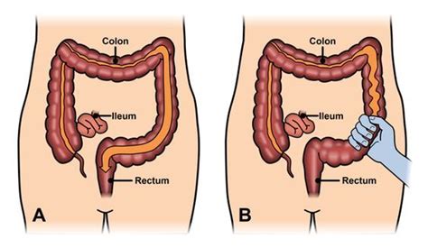 Causes Of Ulcerative Colitis Are Not Well Known But Researchers Include