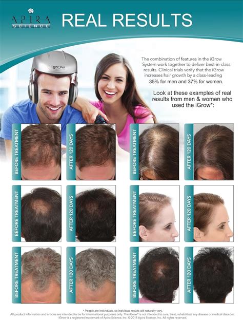 Discover More Than 130 Laser Increases Hair Growth Vn