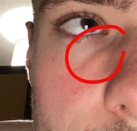 Lump Between Eye And Nose Rmedical