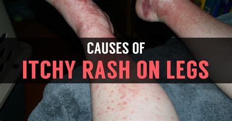Itchy Rash On Legs What Causes Rashes On Skin Of Legs