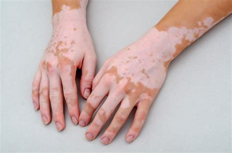 Vitiligo O Que é Sintomas Tratamentos E Causas São Gabriel