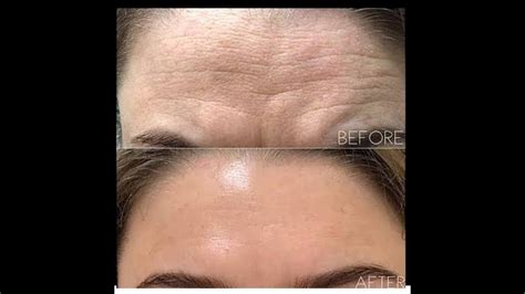 Smart Trick To Rapidly Remove Wrinkles And Fine Lines Of Forehead Part 5