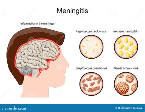 Meningitis Human`s Brain With Inflammation Of The Meninges And